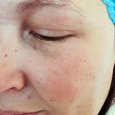 pigmentation-correction